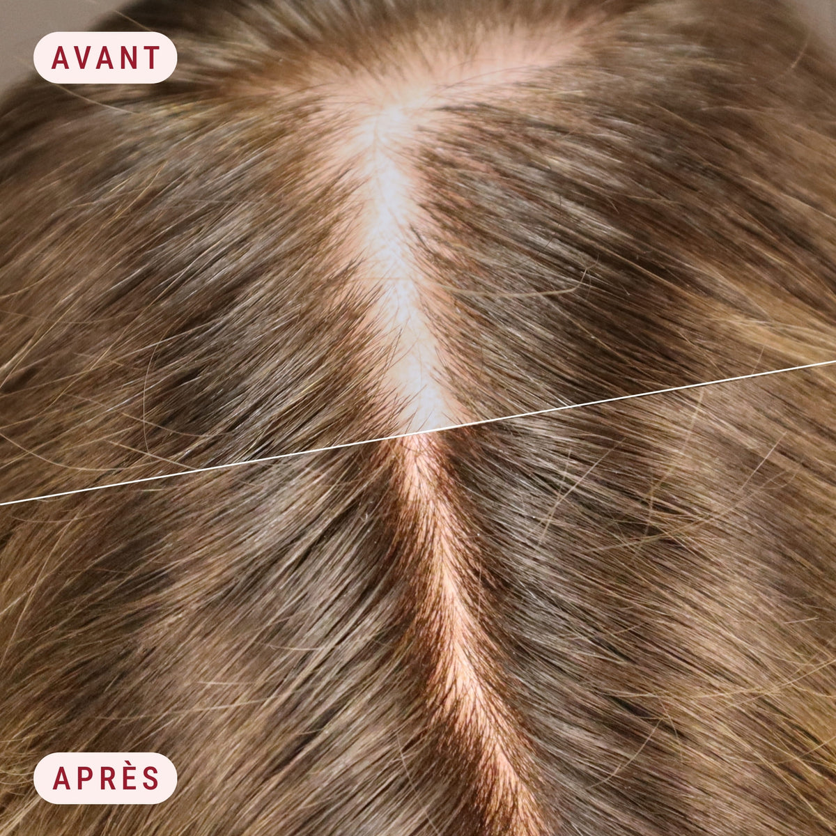 Avant après cuir chevelu montrant une densité capillaire améliorée après 12 semaines de cure avec le Sérum Démélé